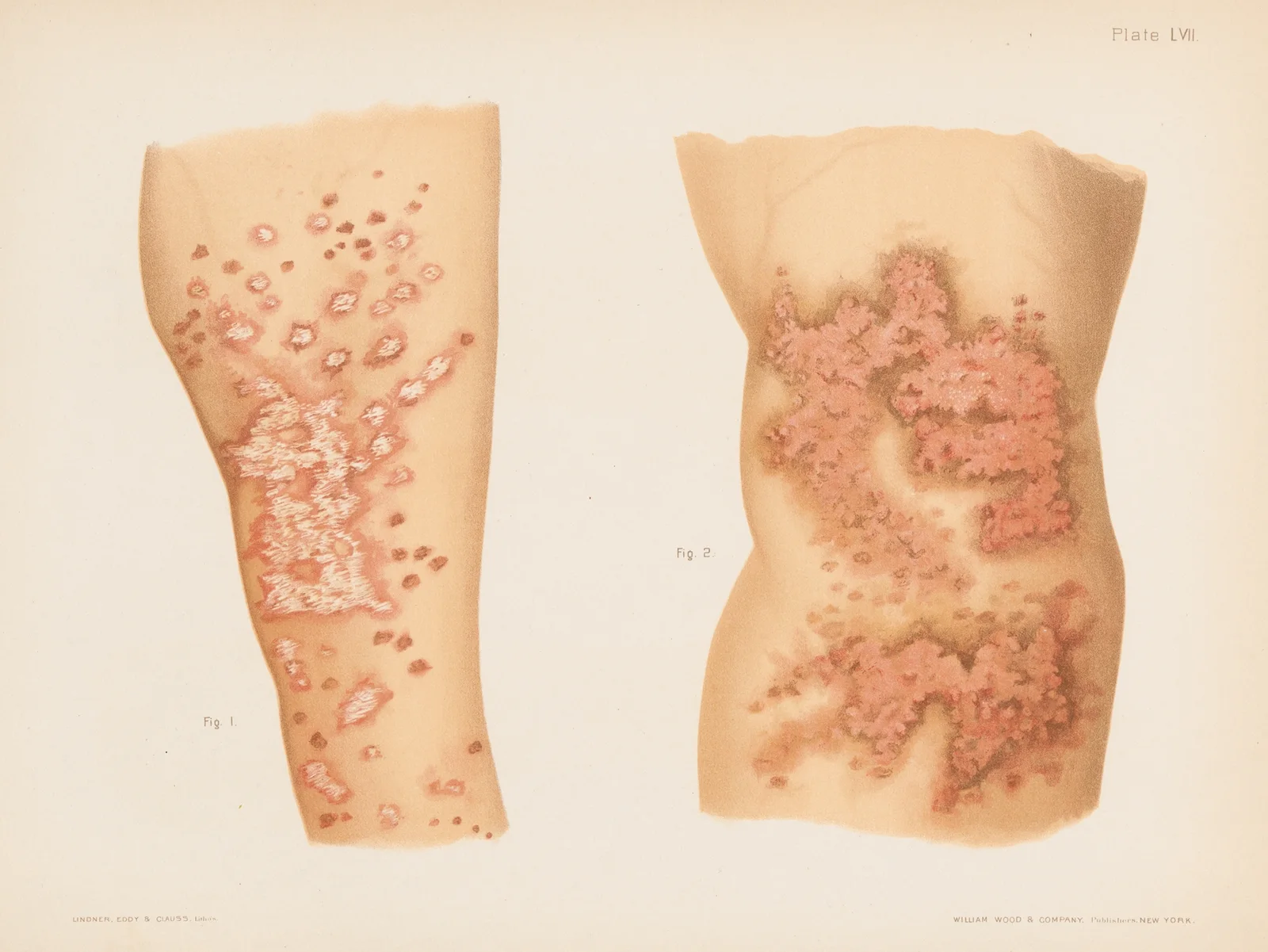 I. Lichen planus, II. Lichen planus av Prince Albert Morrow