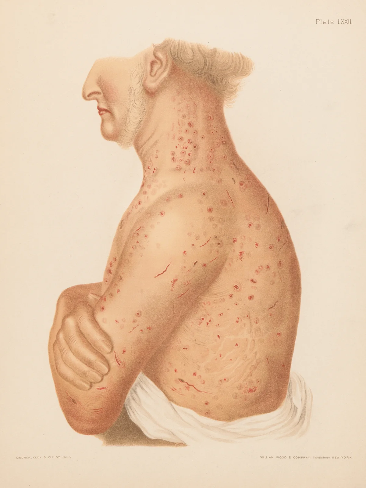 Pediculosis Corporis av Prince Albert Morrow