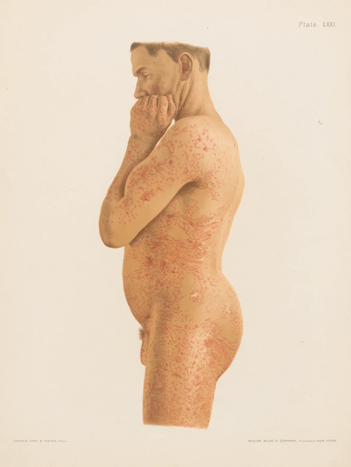 Scabies av Prince Albert Morrow