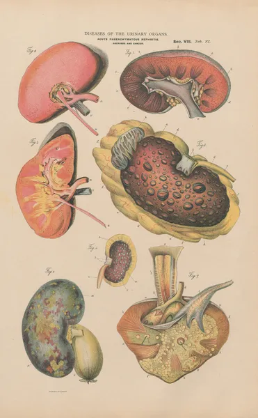 Acute parenchymatous nephritis av Jean Allard Jeancon