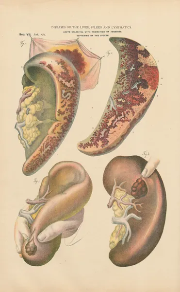 Acute splenitis, with formation of abcesses av Jean Allard Jeancon