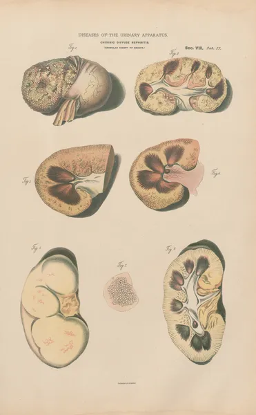 Chronic diffuse nephritis (Granular kidney) av Jean Allard Jeancon