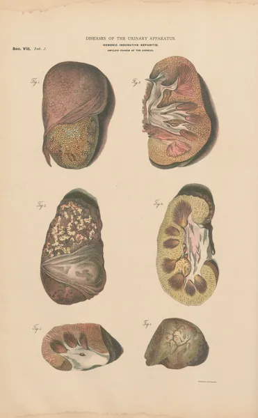 Chronic Nephritis and induration av Jean Allard Jeancon