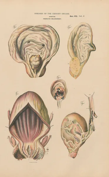 Cystitis and prostatic enlargement. Prostatic calculus. Vesical phlibitis av Jean Allard Jeancon