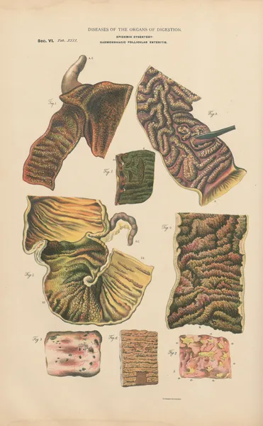 Dysentery. Intestinal Gangrene. Enteric diphtheria av Jean Allard Jeancon