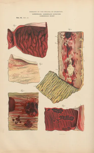 Haemorrhage of mucous membrane of the stomach from mechanical obstruction in the heart av Jean Allard Jeancon