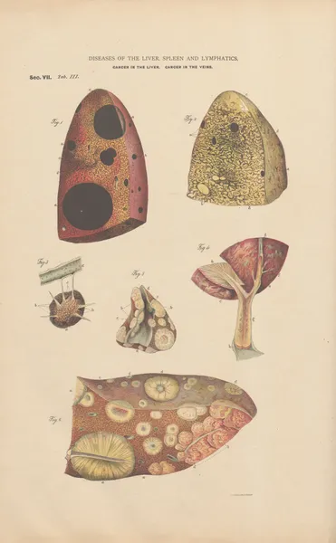 Melanosis of the liver, carcinomata av Jean Allard Jeancon