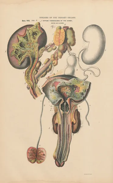 Nephritic tuberculosis with ulceration and inflammation of all urinary organs av Jean Allard Jeancon