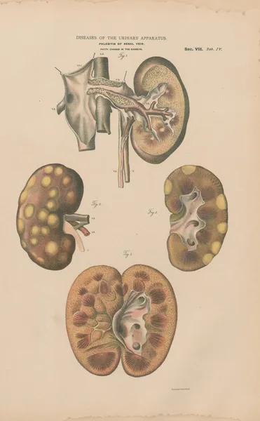 Phlebitis of renal vein. Fatty change av Jean Allard Jeancon