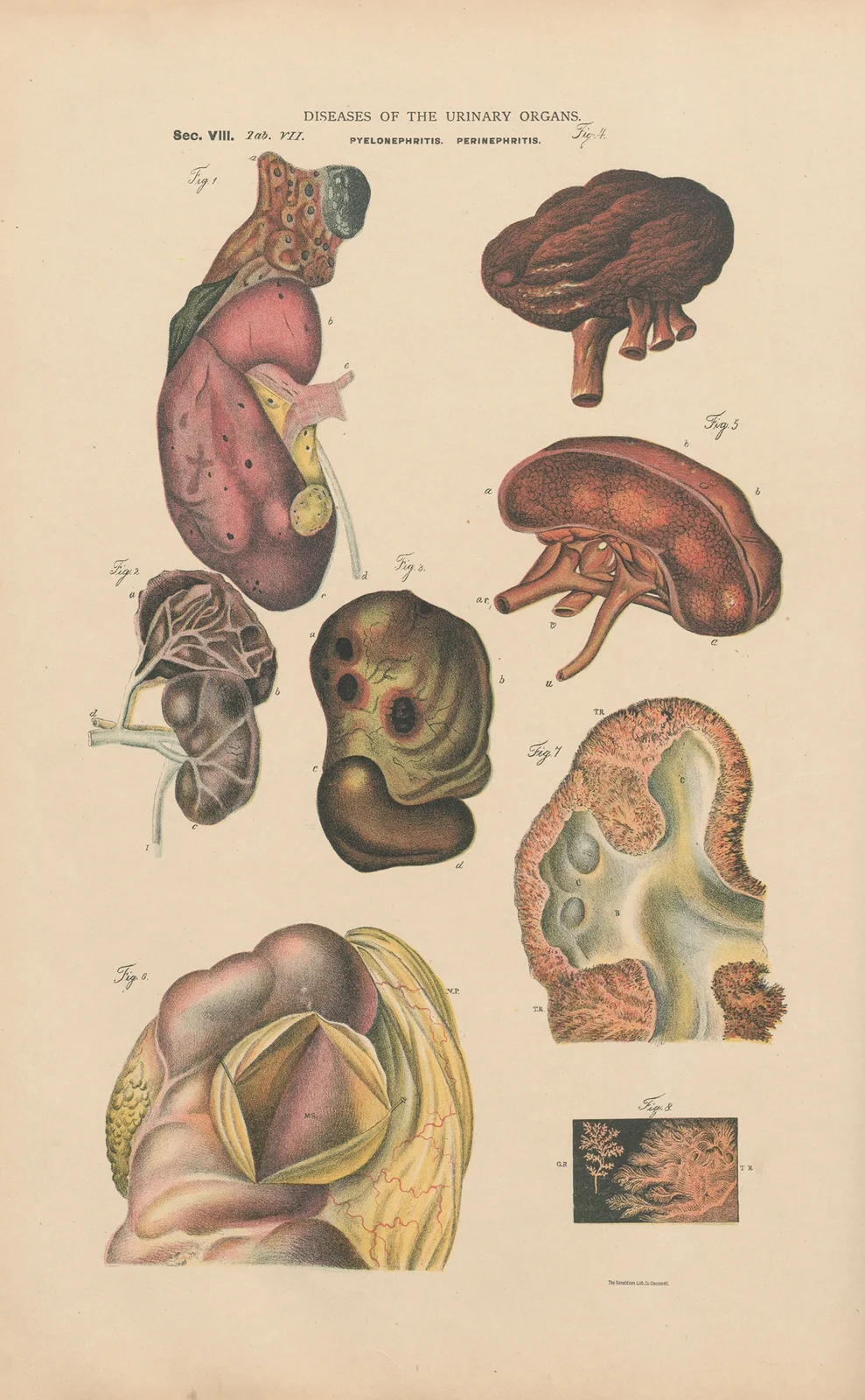 Pyelonephritis and extensive suppuration av Jean Allard Jeancon