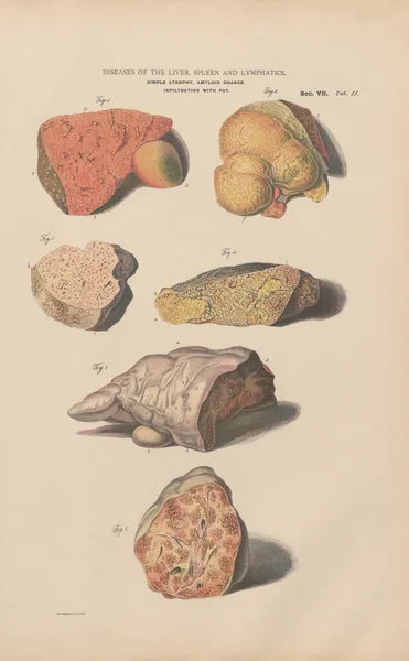 Red atrophy of liver, indurative hypertrophy av Jean Allard Jeancon