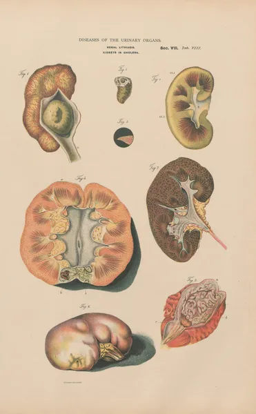 Renal lithiasis. Kidneys in cholera av Jean Allard Jeancon