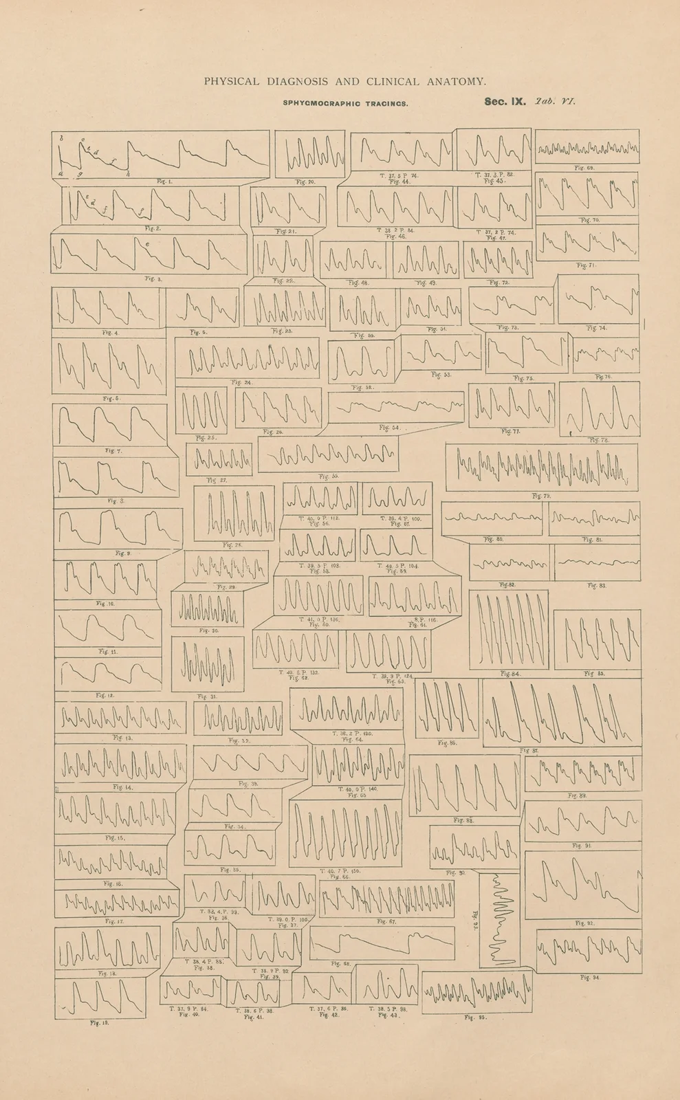 Sphygmographic tracings av Jean Allard Jeancon