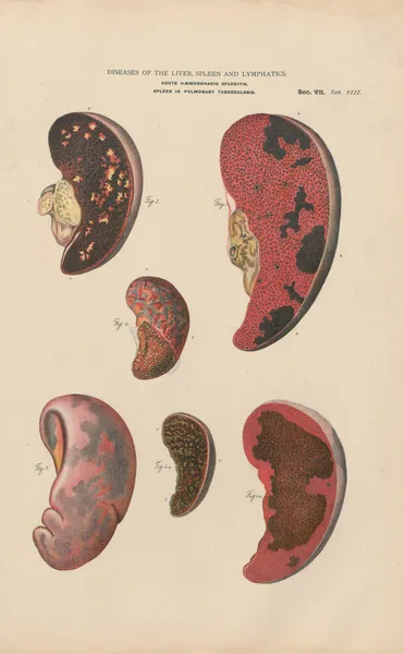 Splenitis and infarct, with abcesses av Jean Allard Jeancon